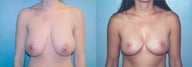 Breast Reduction using Inverted T incision