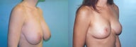 Breast Reduction using Inverted T incision
