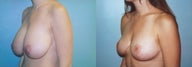 Breast Reduction using Inverted T incision