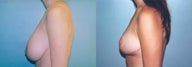 Breast Reduction using Inverted T incision