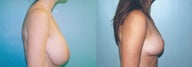 Breast Reduction using Inverted T incision