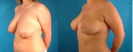 Breast Reduction