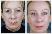 Complete Facial Rejuvenation