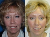 Brow Lift