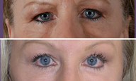 Browlift