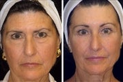 64 year old female, brow lift