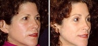56 year old female, brow lift