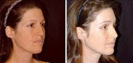 35 year old female, brow lift