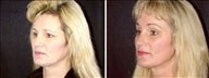 47 year old female, brow lift