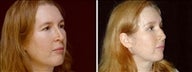 61 year old female, brow lift