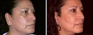 52 year old female, brow lift