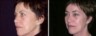 58 year old female, brow lift