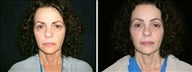 49 year old female, brow lift