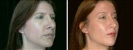 41 year old female, brow lift