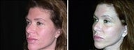 45 year old female, browl lift
