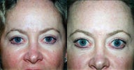 Brow Lift
