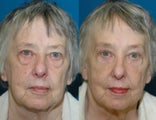 73 year old woman treated with browlift, upper and lower blepharoplasty and fat grafting.