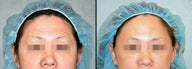 Endoscopic Brow/Forehead Lift