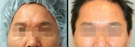Endoscopic Brow Lift