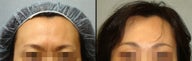 Endoscopic Brow Lift
