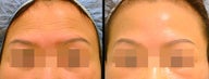 Endoscopic Brow Lift