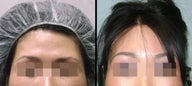 Endoscopic Brow Lift