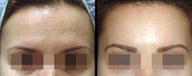Endoscopic Brow Lift by Wave Plastic Surgery & Dermatology Center