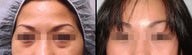 Endoscopic Brow Lift + Lower Eyelid