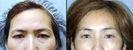 Endoscopic Brow Lift