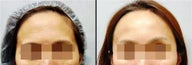 Endoscopic Brow Lift