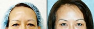 Endoscopic Brow Lift by Wave Plastic Surgery & Dermatology Center