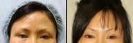Endoscopic Brow Lift
