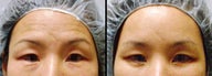 Endoscopic Brow Lift