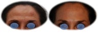 Botox and Lateral Brow Lift