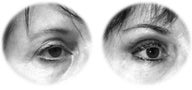 Brow Lift