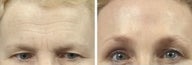 Brow Lift