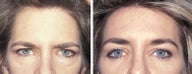 Brow Lift