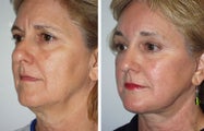 Brow Lift