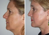 Brow Lift