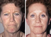 Brow Lift