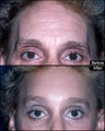 Brow Lift