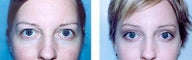Browlift