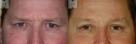 Browlift 