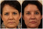 Browlift