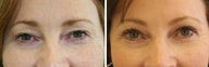51 years old / upper lid blepharoplasty and endoscopic brow lift.