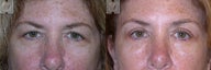Brow Lift