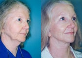 Endoscopic Browlift, 4 lid Blepharoplasty & Modified Facelift