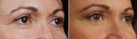 revision upper blepharoplasty-temporal brow lift