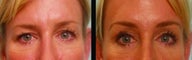 Brow lift