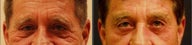 Brow Lift